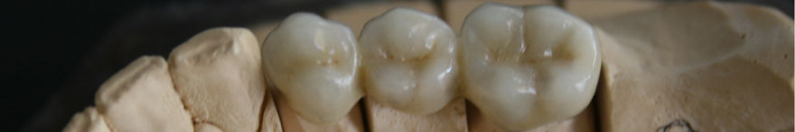 Realizzazione Denti Ceramica