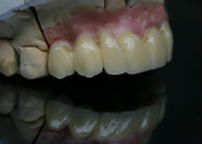 Gruppo Frontale in Zirconio 6