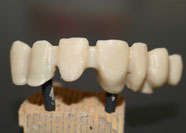 Gruppo Frontale in Zirconio 2