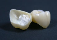 Ceramica Metalfree 2