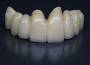 Restauri Dentali - Gruppo Frontale Ceramica