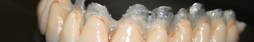 compositi: corone, faccette ed intarsi