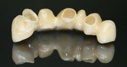 Ponte Zirconio Ceramica