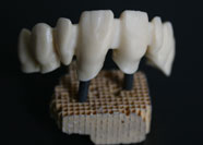 Restauri Dentali - Gruppo Frontale Zirconio