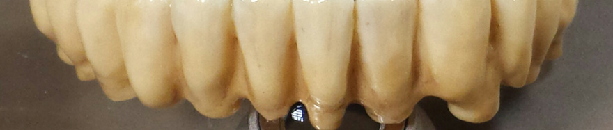 Monolitici in Zirconia